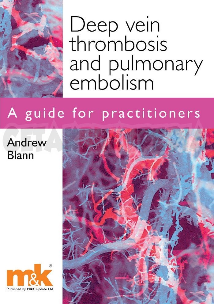 Deep Vein Thrombosis and Pulmonary Embolism a Guide - Cetakebook.com